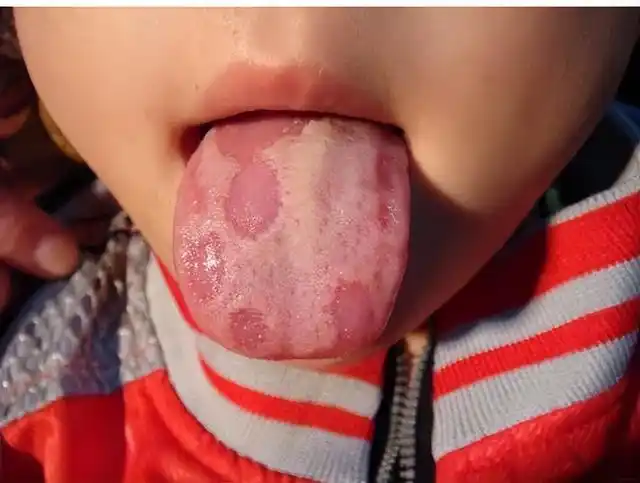 小孩舌头出现"地图舌"是怎么回事,怎么办?