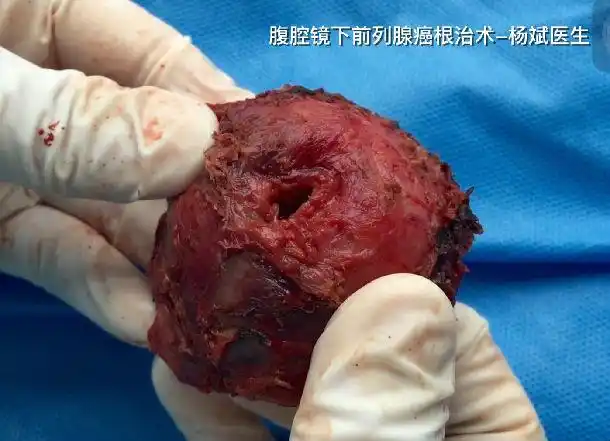 我们术中采用五孔法(5 trocars),行盆腔淋巴结活检,完整切除前列腺与