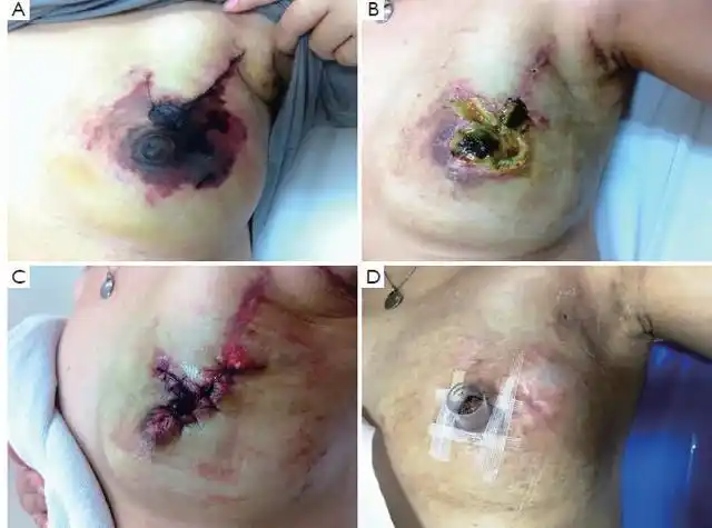 乳房整形手术:安全美容两不误