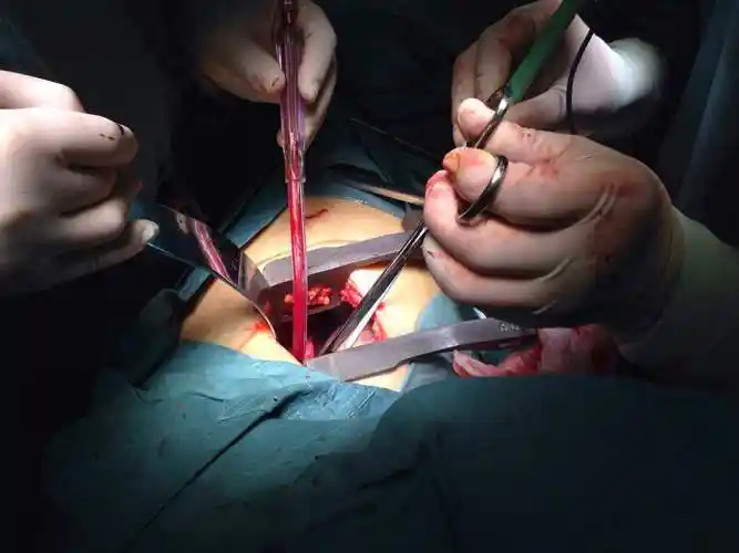 肺结节手术是怎么做的?_肺部结节_肺部结节就诊指导 - 好大夫在线