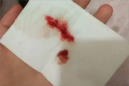 得了新冠咳嗽痰中带血是怎么回事_寻医问药频道_寻医问药网