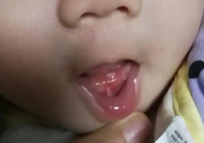 5岁男娃一口烂牙,黑牙,"罪魁祸首"不是糖果,而是妈妈的疏忽