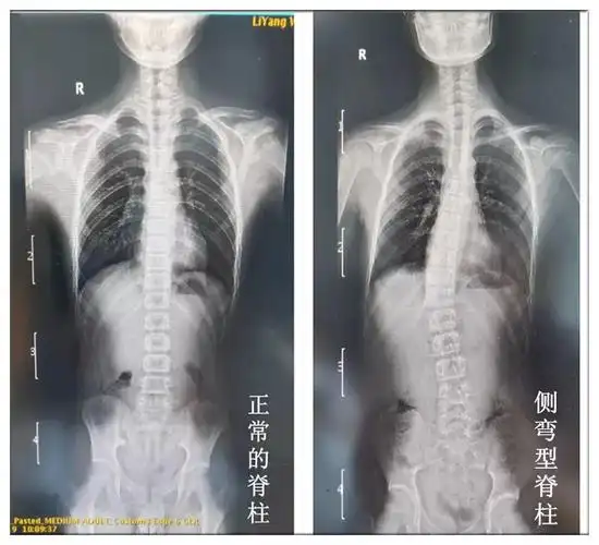 疑似脊柱侧弯?妇保院可以拍全脊柱片咯