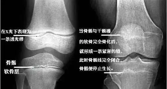 发育科主任蔡西萍一起来了解一下骨骺线是什么,在人的生长发育过程中