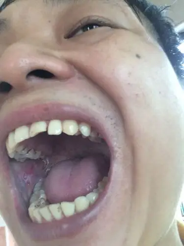 口腔两侧有白色物平时不痛不痒,一旦吃辣吃烫就难受