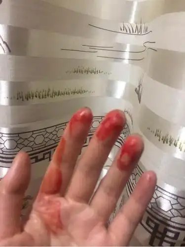 我的鼻炎战记对抗鼻炎的真实经历