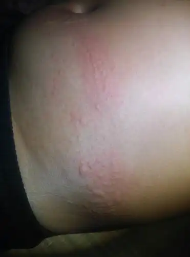 皮肤经常过敏,吃一粒桂利嗪片就会好,过几天又复发.是什么原因?