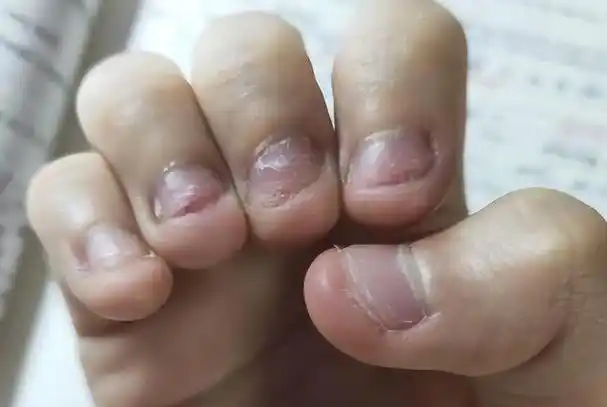 经常咬指甲会对身体造成什么影响?
