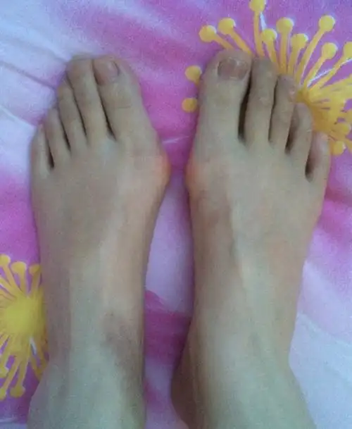 重度拇外翻患者术前图片 中度拇外翻患者术前图片 轻度拇外翻患者术前