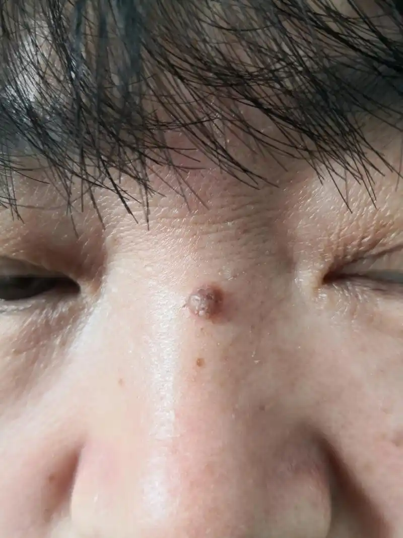 需要手术切除活检诊断一下确定色素痣解决皮肤问题专注皮肤美容皮肤