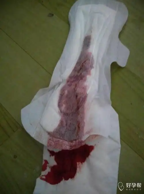 刚怀孕一个月,就流血,三天了,去医院让保胎,可是腰疼还是出血,大夫给