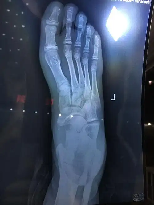 孩子11岁,崴脚脚骨折5天了,肿有淤血,不动不疼,走路就脚酸.