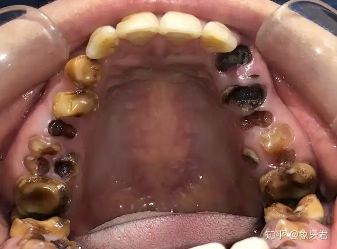 蛀牙不补可以吗? - 知乎