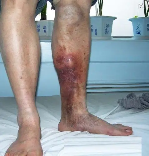 足部浅表型静脉炎图片
