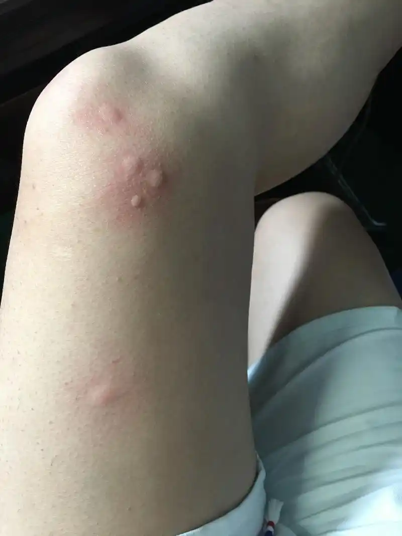 才刚上班一会,就被蚊子咬的全是包.