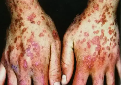 得了病毒疣不要急,看了这篇文章就清楚了