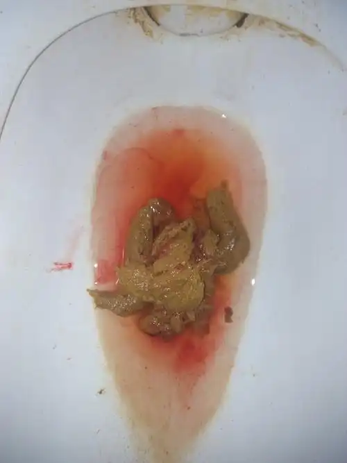 大便便血血量较多便后手纸上有鲜血分不清是否与大便混合前两年有