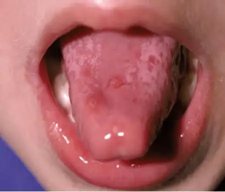 一个传一群手足口病高发季别让孩子做这件事