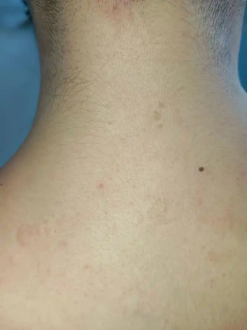 花斑癣俗称汗斑,伍德灯下可见黄褐色荧光#皮肤病 - 抖音