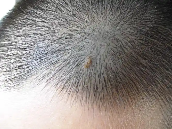 看图诊断头皮疙瘩