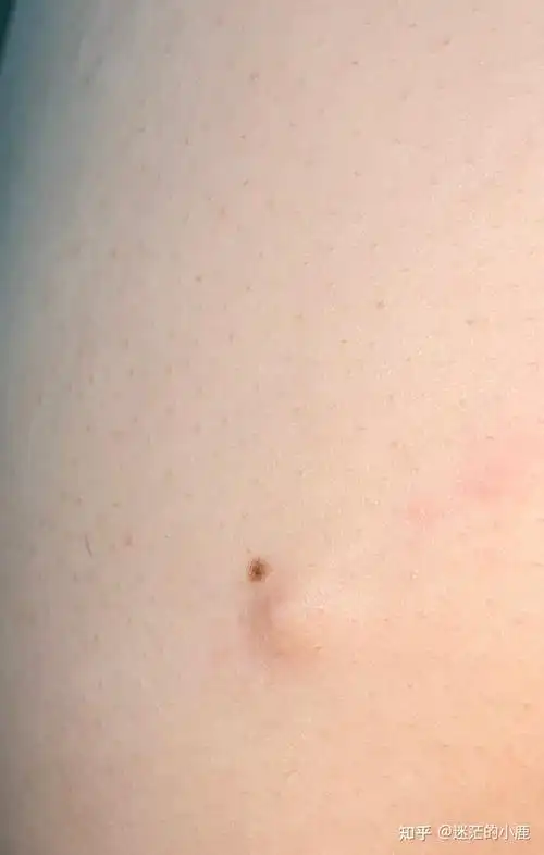 大腿根长了一个包