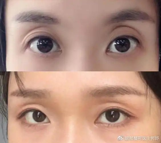 眼窝凹陷该做自体脂肪填充还是全切双眼皮改善?