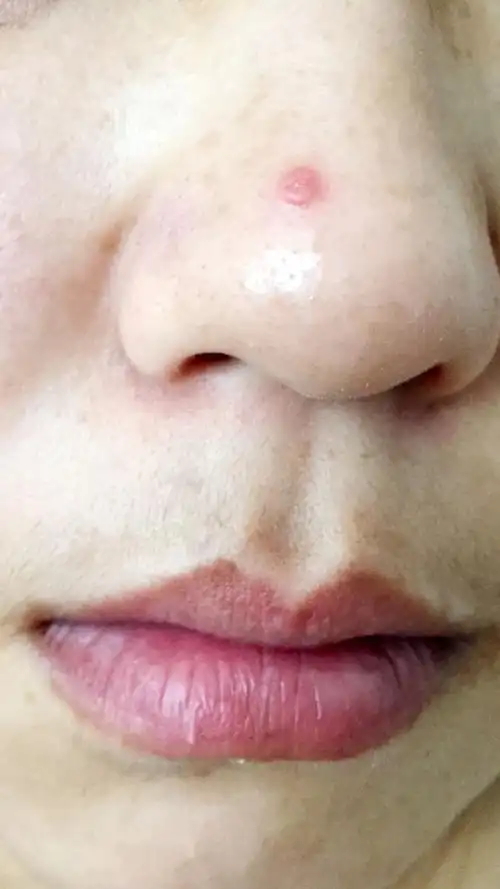 鼻子上这个红疙瘩已经五六年了 不痛不痒 一直不下去 谁能知道是什么