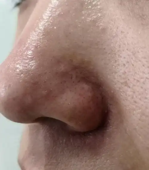 酒糟鼻症状.结节红斑可以使用激光治疗配合药物涂擦治疗减轻症状.