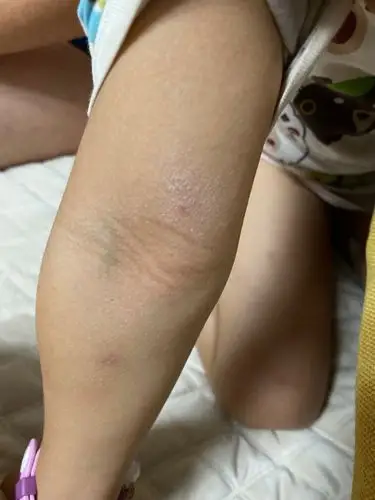 女童胳膊上起癣,家里也没有养宠物,也没有接触小动物;并且总是好不