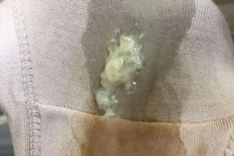 孕妇霉菌症状图片