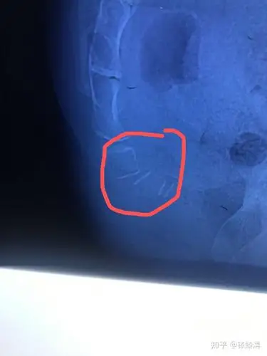 尾骨陈旧错位疼的厉害