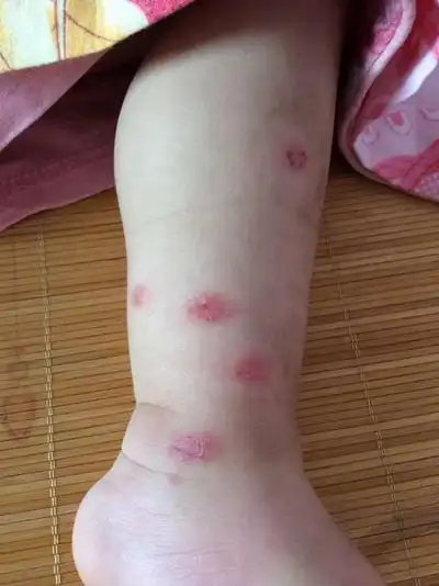 虫咬性皮炎图片 (109)_有来医生