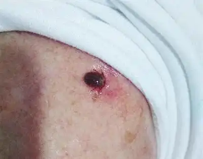 老人肩部被怀疑是蜱虫咬伤