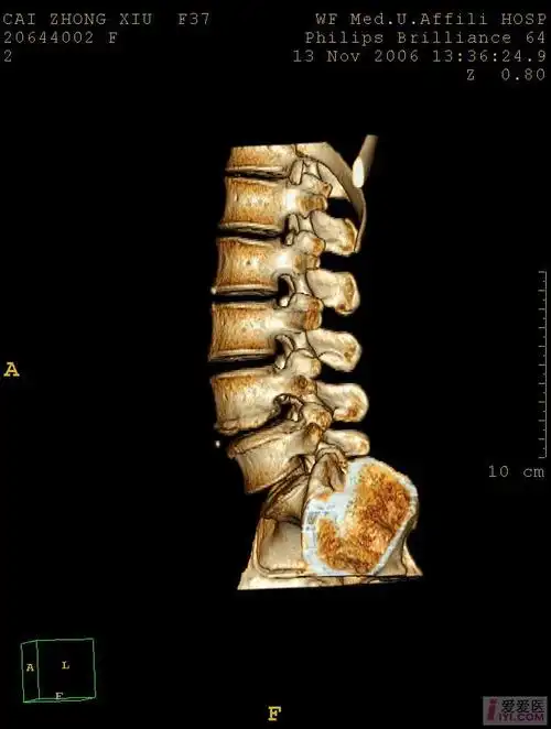 分享典型病例椎弓崩裂患者影像图片
