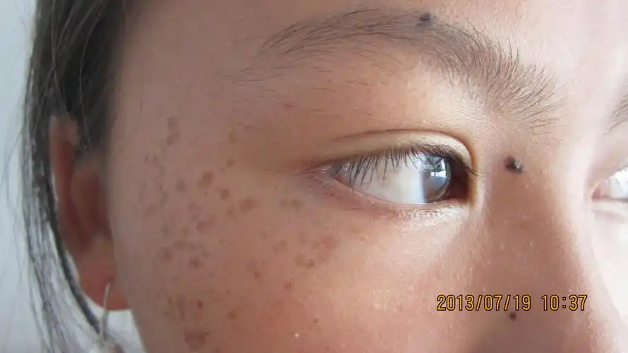 雀斑样痣的病因