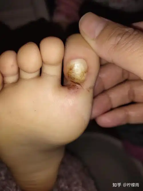 儿童居然也会长跖疣