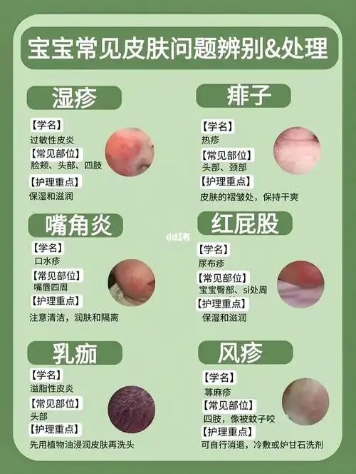 湿疹分为干性湿疹和湿性湿疹.