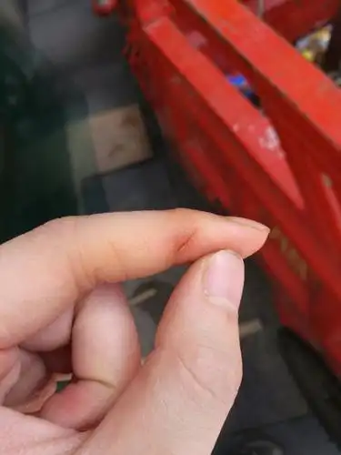 昨天被带有一点锈的铁 划破了手指 伤口不是很深 出了一点血就没出了