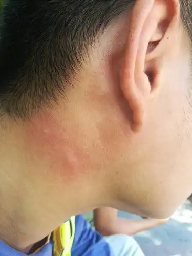 艾滋病症状皮疹图片