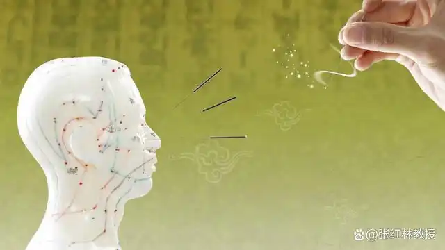 三叉神经痛可以使用针灸治疗吗?具体要根据病因取穴