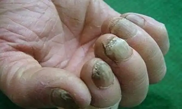 这一个小处方能搞定你长久不愈的灰指甲