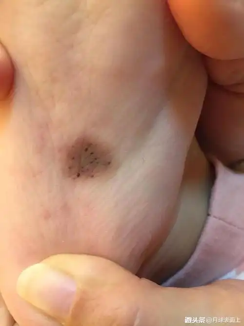 皮徐 的想法: 像这个宝宝脚底板的这个色素痣还是建议在… - 知乎