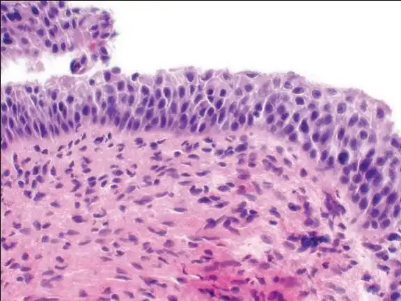 宫颈细胞学解读之非典型鳞状细胞 - 好大夫在线