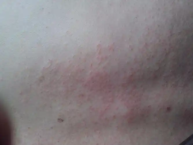 我爸爸背上起了一大片小红疙瘩,很痒,求助,有图