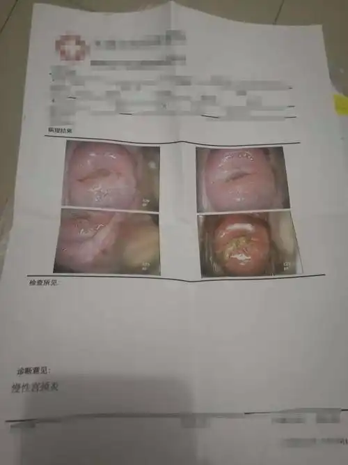 软绵绵!宫颈闭锁怎么治疗效果好"握手言和"-第1张图片-忘川博客