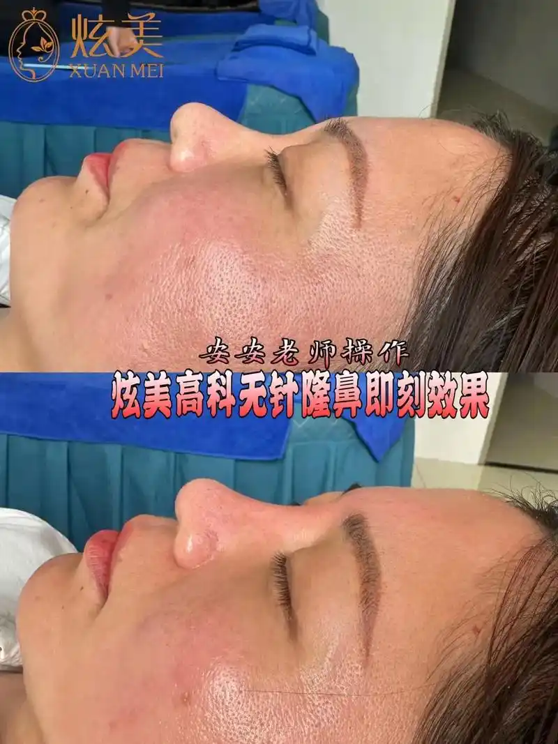 炫美高科 无针隆鼻    三号硬组织的技术优势: 避免玻尿酸 - 抖音