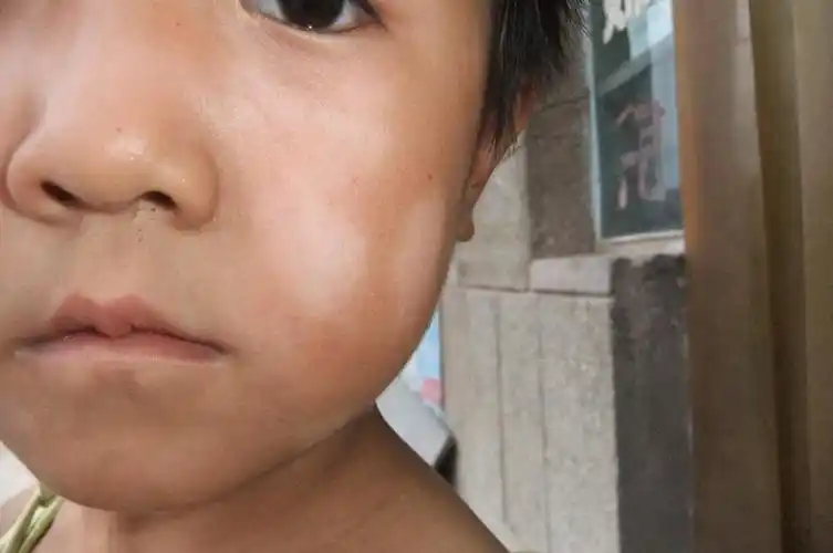 孩子皮肤白了一块是白癜风吗