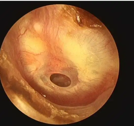 鼓膜穿孔,怎样手术效果好_鼓膜穿孔_鼓膜穿孔治疗方式 - 好大夫在线