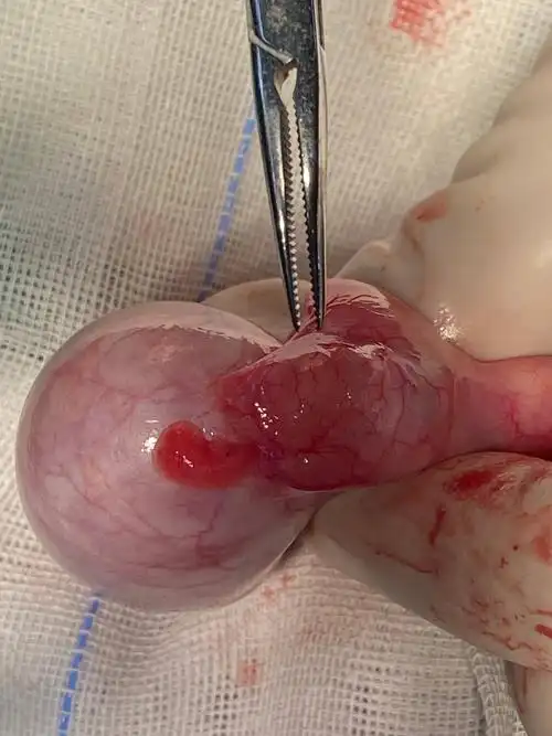 左侧附睾囊肿一例|工作动态 - 小儿外科 - 科室导航 - 就诊指南