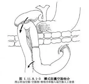 胆囊空肠吻合术的晚期并发症常是因胆管肿瘤的发展或长期的慢性炎症